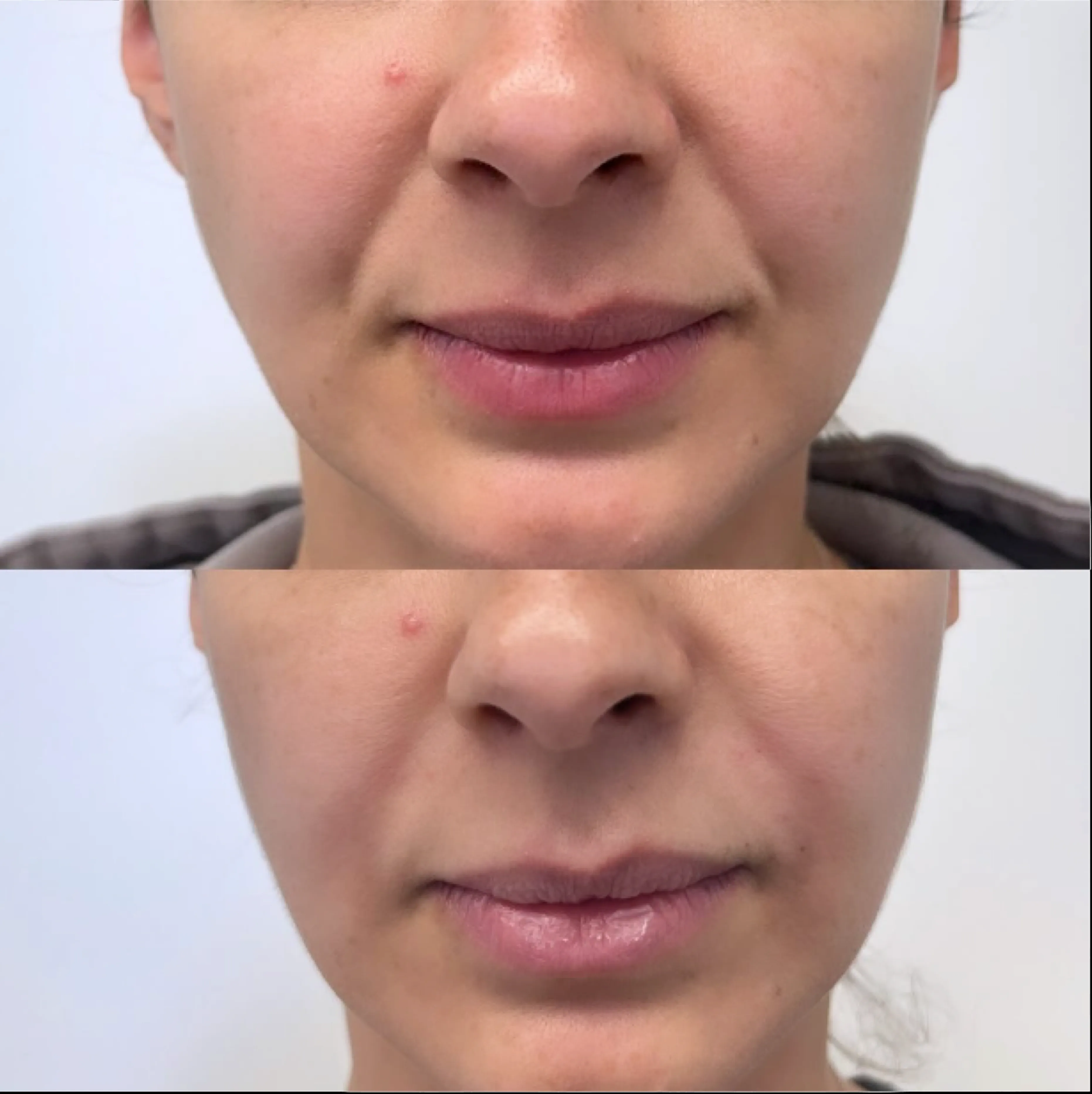 Before and after showing improved facial balance.
