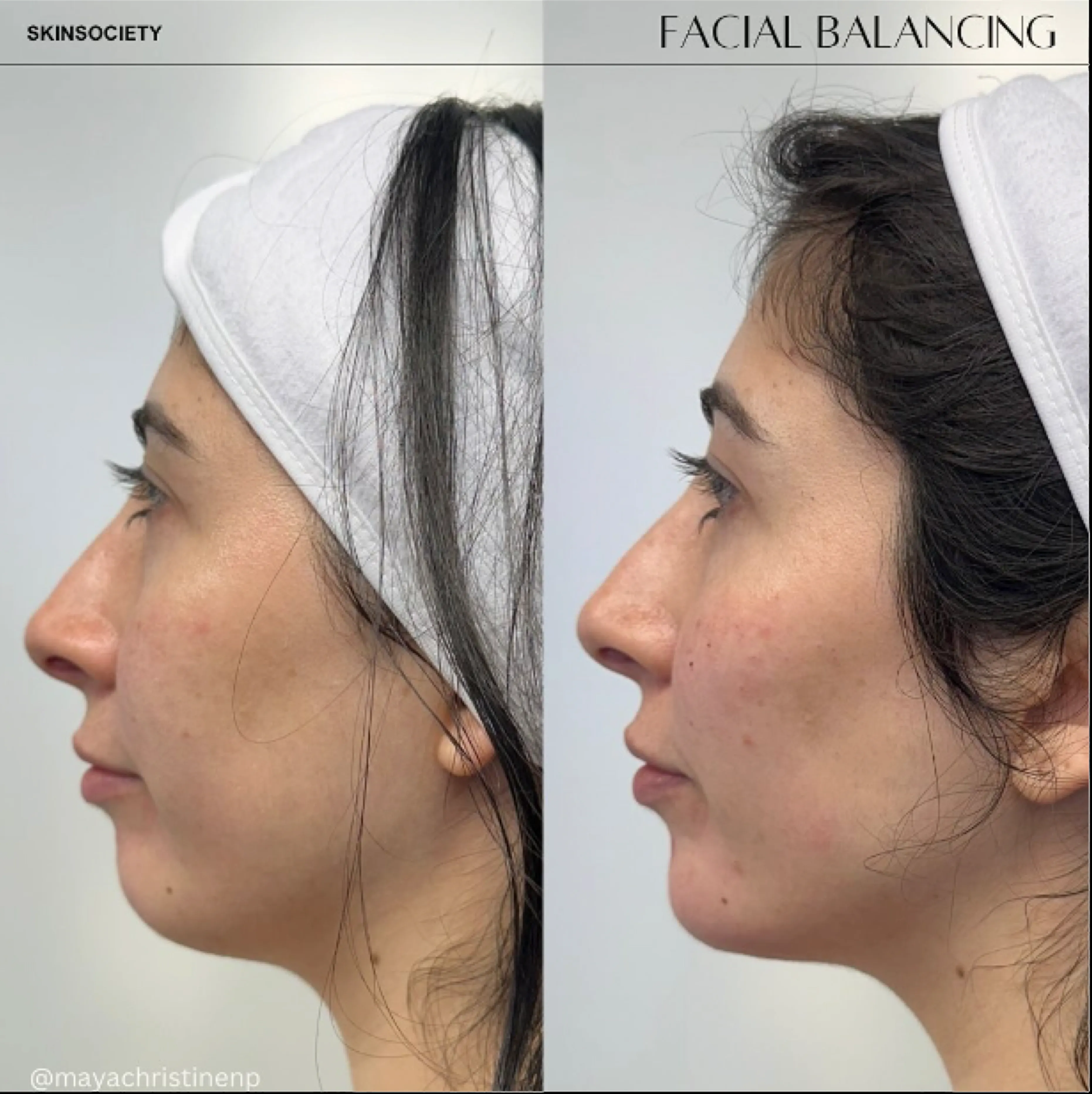 Before and after side profile showing improved facial balance.