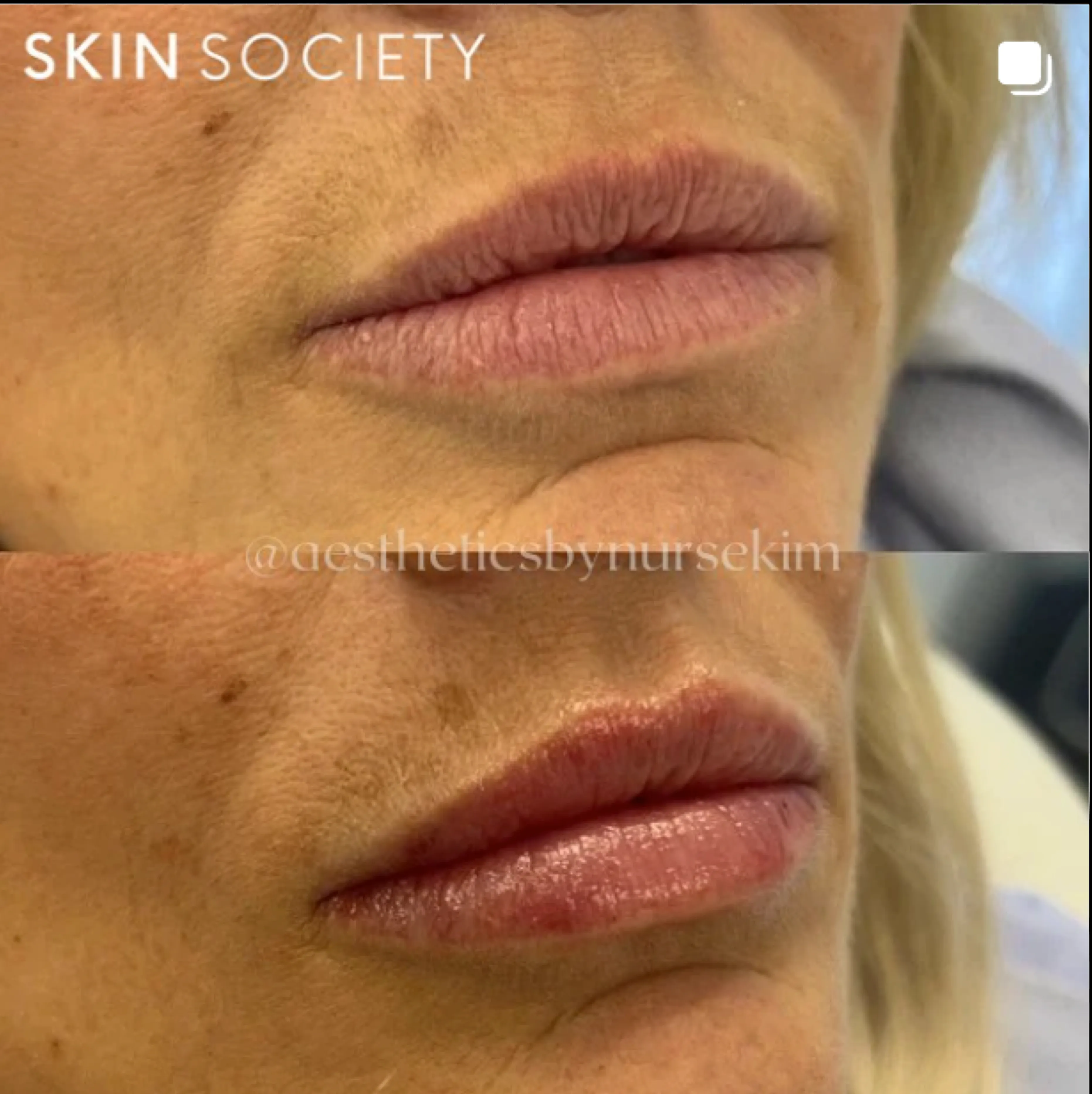 Before and after comparison of lip area, showing reduced wrinkles.