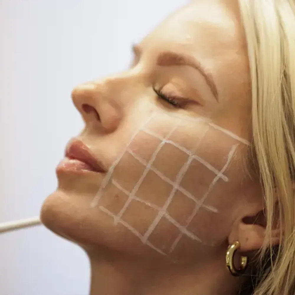 A woman receiving Skinvive treatment on her face.