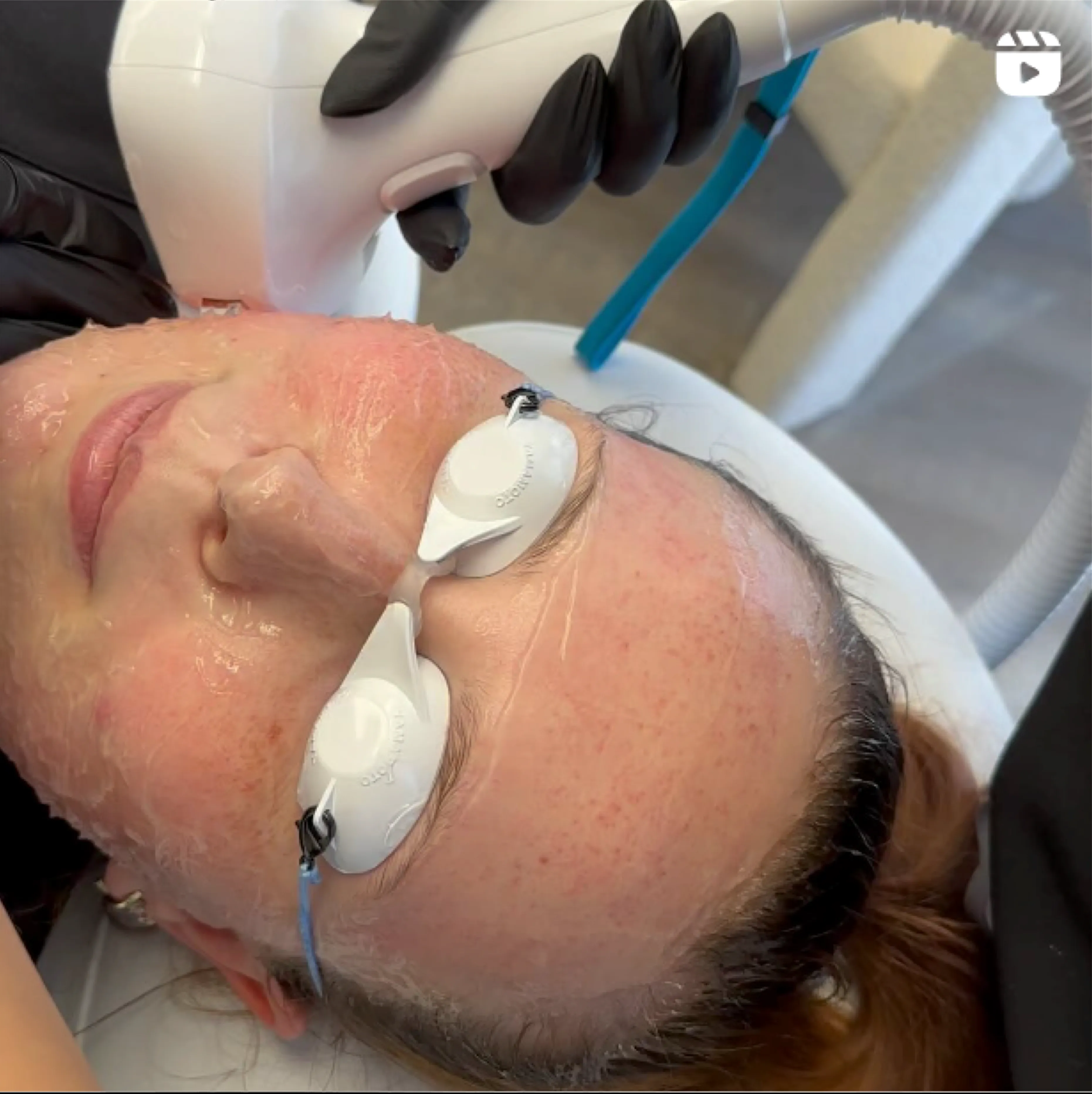Woman with facial gel and eye protectors during cosmetic procedure.